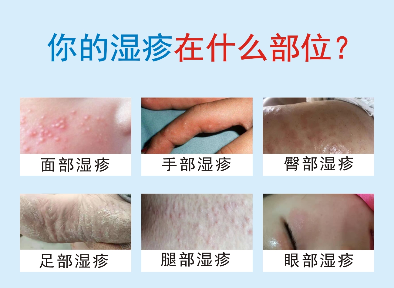湿疹变好的三个阶段